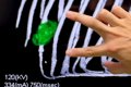 悪性腫瘍で『骨を３…の画像