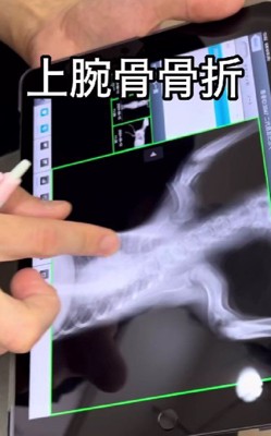骨折してボロボロだった