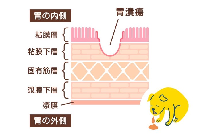 胃潰瘍の図解